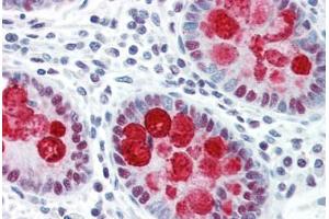 Human Colon (formalin-fixed, paraffin-embedded) stained with DFFA antibody ABIN461876 at 10 ug/ml followed by biotinylated goat anti-rabbit IgG secondary antibody ABIN481713, alkaline phosphatase-streptavidin and chromogen.