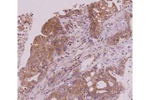 Immunohistochemistry paraffin embedded sections of human colorectal cancer tissue were incubated with monoclonal CLEC4E monoclonal antibody, clone AT16E3  (1 : 50) for 2 hours at room temperature. (CLEC4E anticorps  (AA 41-219))