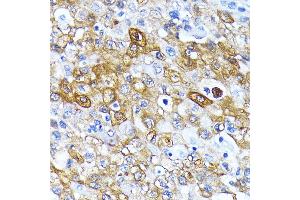 Immunohistochemistry of paraffin-embedded human esophageal cancer using  antibody  at dilution of 1:100 (40x lens).