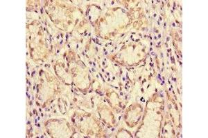 Immunohistochemistry of paraffin-embedded human gastric cancer using ABIN7160996 at dilution of 1:100 (ME1 anticorps  (AA 161-519))
