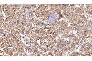 ABIN6276582 at 1/100 staining Human Melanoma tissue by IHC-P.