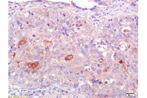 Formalin-fixed and paraffin embedded human lung carcinoma labeled with Anti-CNR2/CB2 Polyclonal Antibody, Unconjugated  at 1:200 followed by conjugation to the secondary antibody and DAB staining. (CNR2 anticorps  (AA 251-350))