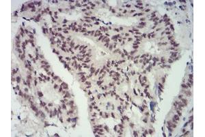 Immunohistochemical analysis of paraffin-embedded rectum cancer tissues using CBX4 mouse mAb with DAB staining.