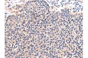 The image on the left is immunohistochemistry of paraffin-embedded Human lung cancer tissue using ABIN7190092(CCL7 Antibody) at dilution 1/20, on the right is treated with synthetic peptide. (CCL7 anticorps)
