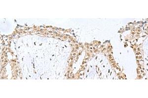 Immunohistochemistry of paraffin-embedded Human breast cancer tissue using KDM2B Polyclonal Antibody at dilution of 1:50(x200)