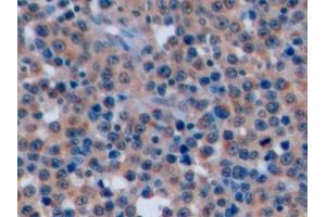 Detection of CD7 in Human Lymphoma Tissue using Polyclonal Antibody to Cluster Of Differentiation 7 (CD7) (CD7 anticorps  (AA 26-134))