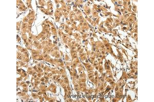 Immunohistochemistry of Human thyroid cancer using MAP1A Polyclonal Antibody at dilution of 1:40 (MAP1A anticorps)