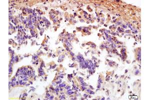 Formalin-fixed and paraffin embedded human rectal carcinoma labeled with Anti MCP1/CCL2 Polyclonal Antibody (ABIN675863), Unconjugated at 1:200, followed by conjugation to the secondary antibody and DAB staining (CCL2 anticorps)