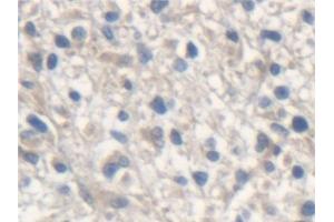 Detection of ME2 in Human Glioma Tissue using Polyclonal Antibody to Malic Enzyme 2, NADP+ Dependent, Mitochondrial (ME2) (Malic Enzyme 2, NADP+ Dependent, Mitochondrial (AA 220-426) anticorps)