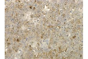 ABIN6259072 and ABIN6273576 at 1/100 staining human melanoma by IHC-P. (VSIG2 anticorps  (Internal Region))