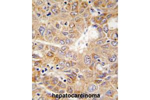 Formalin-fixed and paraffin-embedded human hepatocarcinomareacted with PGK1 polyclonal antibody , which was peroxidase-conjugated to the secondary antibody, followed by AEC staining. (PGK1 anticorps  (Internal Region))