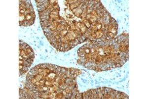 IHC testing of FFPE human colon carcinoma with MAML3 antibody (clone MMLP3-1).