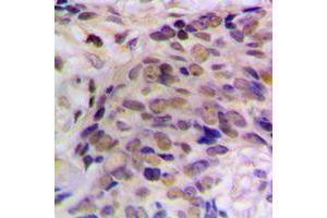Immunohistochemical analysis of HES6 staining in human prostate cancer formalin fixed paraffin embedded tissue section. (HES6 anticorps  (N-Term))