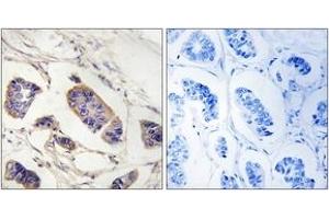 Immunohistochemistry analysis of paraffin-embedded human breast carcinoma tissue, using PEX7 Antibody. (PEX7 anticorps  (AA 204-253))