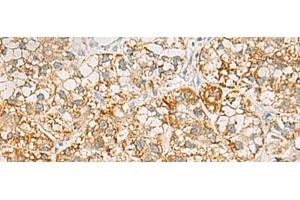 Immunohistochemistry of paraffin-embedded Human liver cancer tissue using SH3YL1 Polyclonal Antibody at dilution of 1:55(x200) (SH3YL1 anticorps)