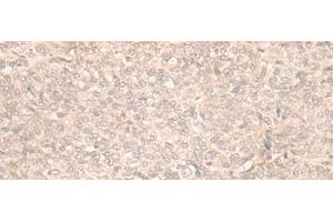 Immunohistochemistry of paraffin-embedded Human ovarian cancer tissue using FAN1 Polyclonal Antibody at dilution of 1:30(x200) (FAN1 anticorps)