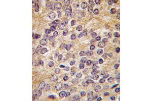 Formalin-fixed and paraffin-embedded human prostata carcinoma tissue reacted with PLAU antibody (C-term ), which was peroxidase-conjugated to the secondary antibody, followed by DAB staining.