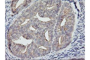 Immunohistochemical staining of paraffin-embedded Adenocarcinoma of Human endometrium tissue using anti-RTN4IP1 mouse monoclonal antibody. (RTN4IP1 anticorps  (AA 41-279))