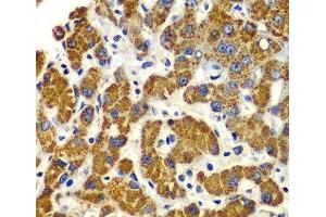 Immunohistochemistry of paraffin-embedded Human liver damage using SMAD9 Polyclonal Antibody at dilution of 1:100 (40x lens). (SMAD9 anticorps)