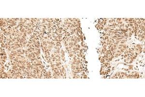 Immunohistochemistry of paraffin-embedded Human ovarian cancer tissue using LGALS4 Polyclonal Antibody at dilution of 1:30(x200)