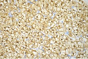 Immunohistochemistry was performed on paraffin-embedded human renal carcinoma using enolase 1 antibody (ABIN7798448), 1:200).