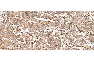 Immunohistochemistry of paraffin-embedded Human liver cancer tissue using FAAP24 Polyclonal Antibody at dilution of 1:30(x200)
