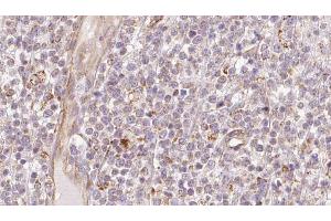 ABIN6273208 at 1/100 staining Human lymph cancer tissue by IHC-P. (CHCHD4 anticorps  (N-Term))