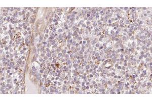 ABIN6273208 at 1/100 staining Human lymph cancer tissue by IHC-P. (CHCHD4 anticorps  (N-Term))