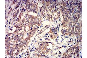 Immunohistochemical analysis of paraffin-embedded bladder cancer tissues using GRM3 mouse mAb with DAB staining.