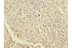 Immunohistochemistry of paraffin-embedded human lung cancer using ABIN7163118 at dilution of 1:100