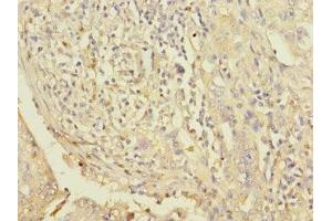 Immunohistochemistry of paraffin-embedded human lung cancer using ABIN7163118 at dilution of 1:100 (Lipin 1 anticorps  (AA 741-890))