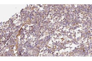 ABIN6276608 at 1/100 staining Human Melanoma tissue by IHC-P. (DEFB121 anticorps  (Internal Region))