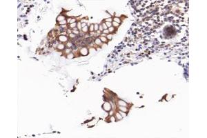 ABIN6267477 at 1/200 staining human colon cancer tissue sections by IHC-P.