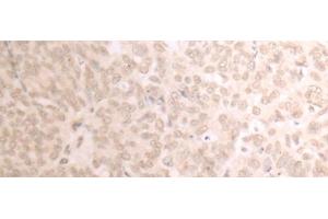 Immunohistochemistry of paraffin-embedded Human ovarian cancer tissue using TRMT1 Polyclonal Antibody at dilution of 1:25(x200)
