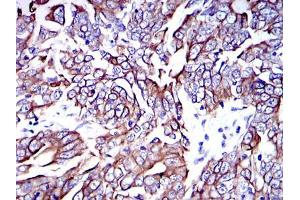 Immunohistochemical analysis of paraffin-embedded human stomach cancer tissues using KRT19 mouse mAb with DAB staining. (Cytokeratin 19 anticorps)