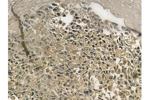 ABIN6257045 and ABIN6275049 at 1/100 staining human prostate carcinoma by IHC-P. (AGBL2 anticorps  (C-Term))