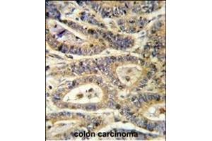 Formalin-fixed and paraffin-embedded human colon carcinoma reacted with IGFBP6 Antibody (C-term), which was peroxidase-conjugated to the secondary antibody, followed by DAB staining. (IGFBP6 anticorps  (C-Term))