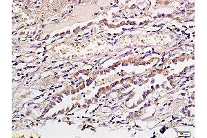 Formalin-fixed and paraffin embedded human gastric cancer labeled with Anti CD1a/Cortical thymocyte antigen CD1A Polyclonal Antibody, Unconjugated (ABIN704096) at 1:300 followed by conjugation to the secondary antibody and DAB staining (CD1a anticorps  (AA 151-250))