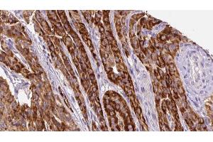 ABIN6267133 at 1/100 staining Human thyroid cancer tissue by IHC-P. (LAT anticorps  (pTyr200))