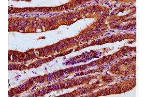 IHC image of ABIN7174418 diluted at 1:300 and staining in paraffin-embedded human colon cancer performed on a Leica BondTM system. (UBAC2 anticorps  (AA 1-157))