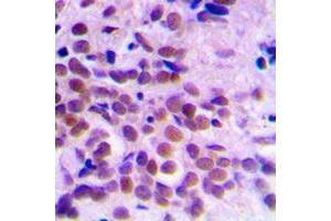 Immunohistochemical analysis of CDC2 staining in human breast cancer formalin fixed paraffin embedded tissue section.