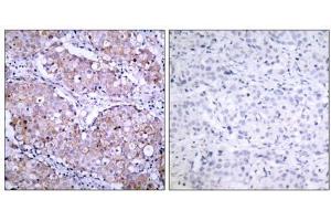 Immunohistochemical analysis of paraffin- embedded human breast carcinoma tissue, using (EGFR anticorps  (pSer1070))