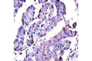 AKT2 antibody immunohistochemistry analysis in formalin fixed and paraffin embedded human lung adenocarcinoma. (AKT2 anticorps  (AA 93-123))