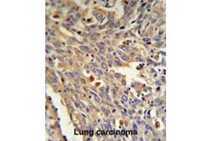 GLA Antibody (N-term) IHC analysis in formalin fixed and paraffin embedded human Lung carcinoma followed by peroxidase conjugation of the secondary antibody and DAB staining. (GLA anticorps  (N-Term))