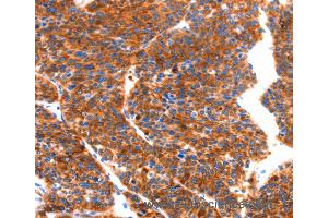 Immunohistochemistry of Human thyroid cancer using SEPT4 Polyclonal Antibody at dilution of 1:50 (Septin 4 anticorps)