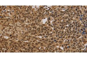 Immunohistochemistry of paraffin-embedded Human cervical cancer using BRAF Polyclonal Antibody at dilution of 1:30 (BRAF anticorps)