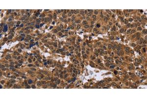 Immunohistochemistry of paraffin-embedded Human cervical cancer using EDN2 Polyclonal Antibody at dilution of 1:30