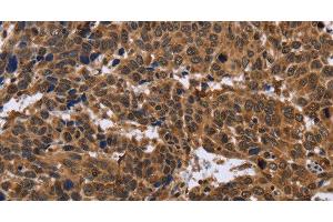 Immunohistochemistry of paraffin-embedded Human cervical cancer using EDN2 Polyclonal Antibody at dilution of 1:30 (Endothelin 2 anticorps)