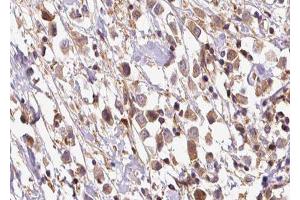 ABIN6278255 at 1/100 staining Human breast cancer tissue by IHC-P. (OS9 anticorps  (Internal Region))