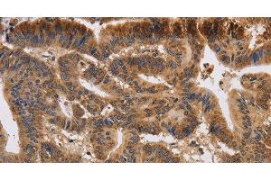 Immunohistochemistry of paraffin-embedded Human colon cancer using KCNK9 Polyclonal Antibody at dilution of 1:40 (KCNK9 anticorps)